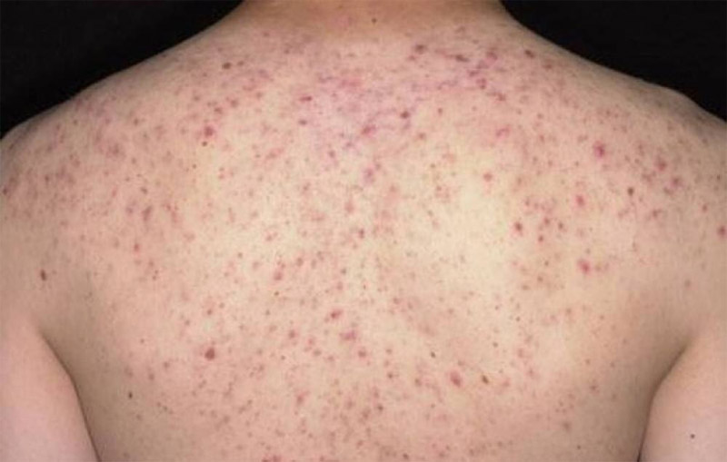 Chia sẻ cách điều trị viêm nang lông đơn giản tại nhà