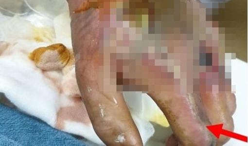 Chữa rắn độc cắn bằng thuốc nam, nam thanh niên bị hoại tử bàn tay