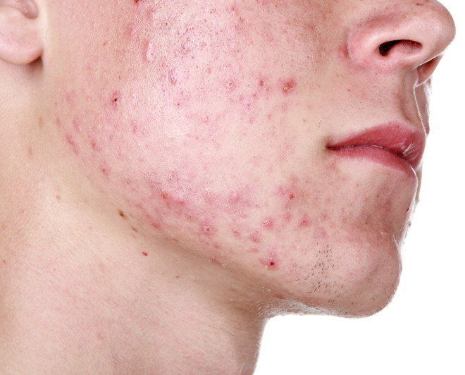 Thuốc Isotretinoin điều trị trứng cá hoặc mụn nang nghiêm trọng