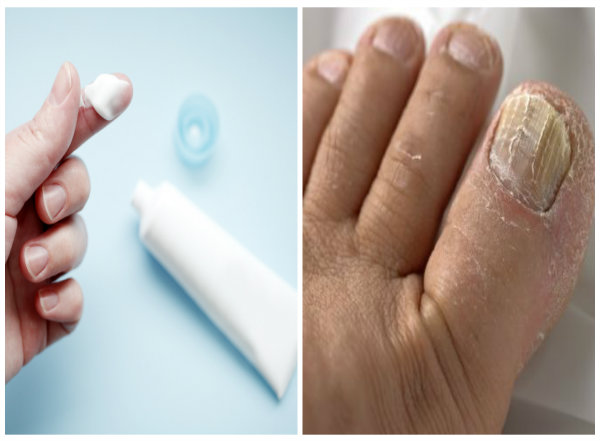 Sử dụng Ketoconazole như thế n&agrave;o cho đ&uacute;ng l&agrave; điều nhiều người quan t&acirc;m