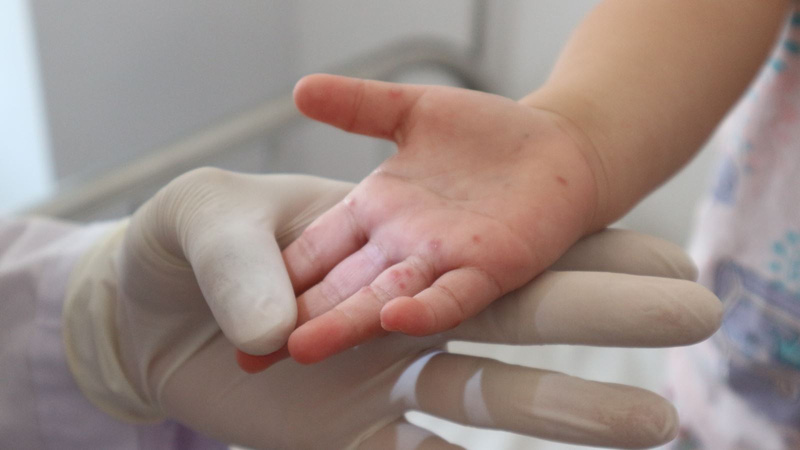 Đắk Lắk: Gần 290 ca mắc, 1 ca tử vong do tay chân miệng