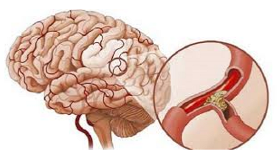 Dấu hiệu nhận biết bệnh xơ vữa động mạch não để có phương pháp điều trị kịp thời