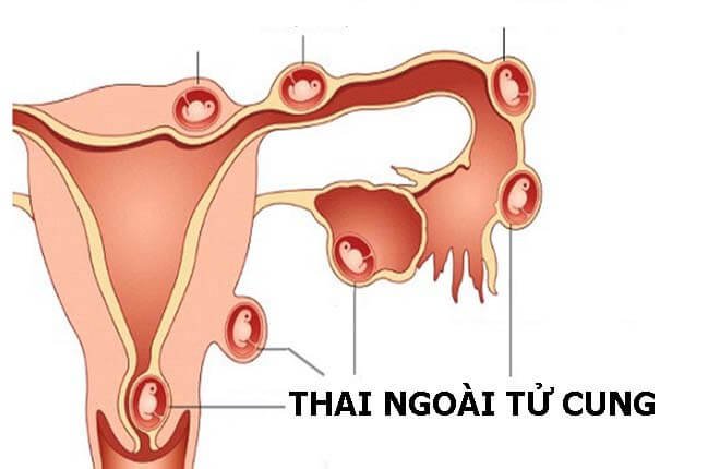 Dấu hiệu nhận biết mang thai ngoài tử cung và cách điều trị hiệu quả