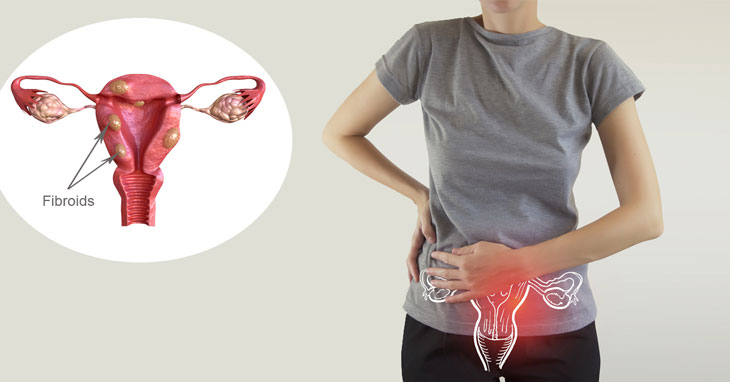 Dấu hiệu nhận biết sớm u xơ tử cung các chị em cần biết