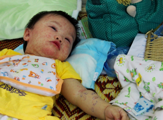 Bệnh sởi c&oacute; nguy hiểm kh&ocirc;ng?