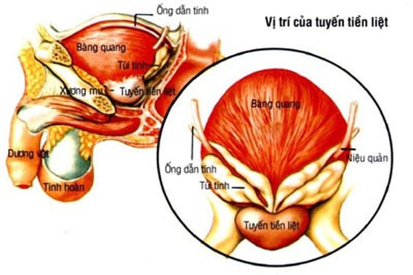u xơ tiền liệt tuyến 