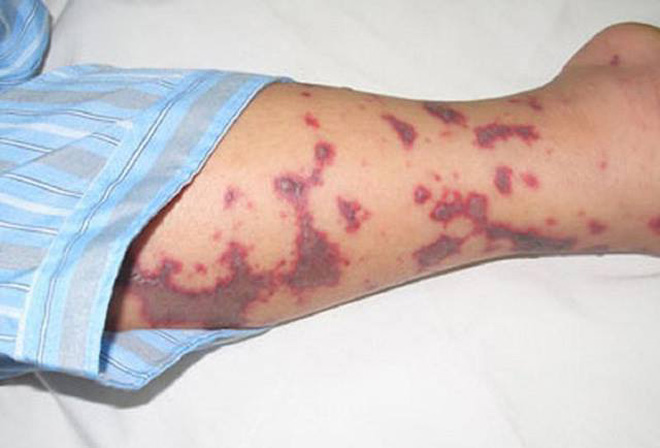 Điều trị bệnh nhiễm khuẩn huyết não mô cầu và cách phòng ngừa hiệu quả