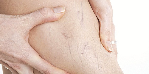 Thuốc Daflon c&oacute; hiệu quả trong điều trị bệnh suy tĩnh mạch mạn t&iacute;nh