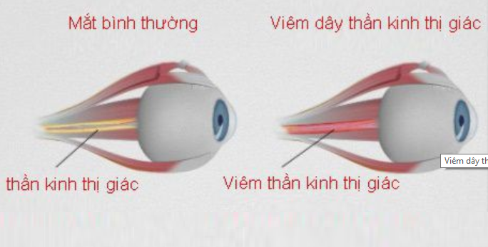 Điều trị phục hồi bệnh viêm dây thần kinh thị giác như thế nào?