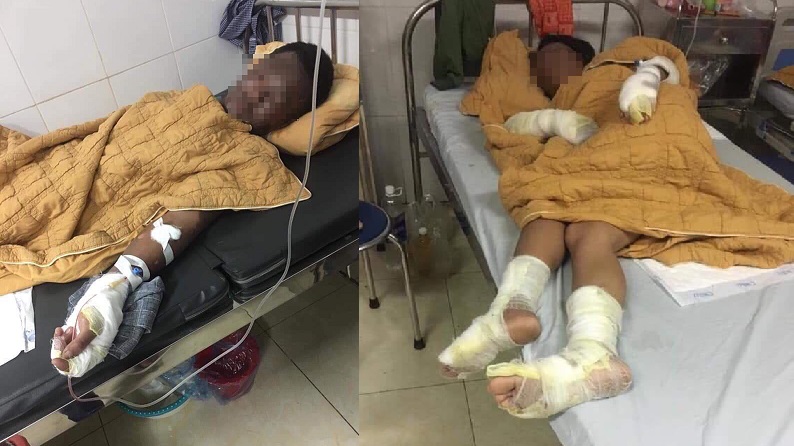 Dùng bình gas để khò (thui) chó, 2 vợ chồng và con 7 tháng tuổi bỏng toàn thân