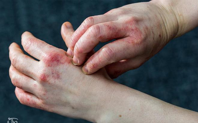 Eczema là bệnh gì? Nguyên nhân và cách điều trị hiệu quả nhất