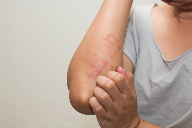 Việc dùng thuốc trị eczema phải tuân thủ theo chỉ định của bác sĩ
