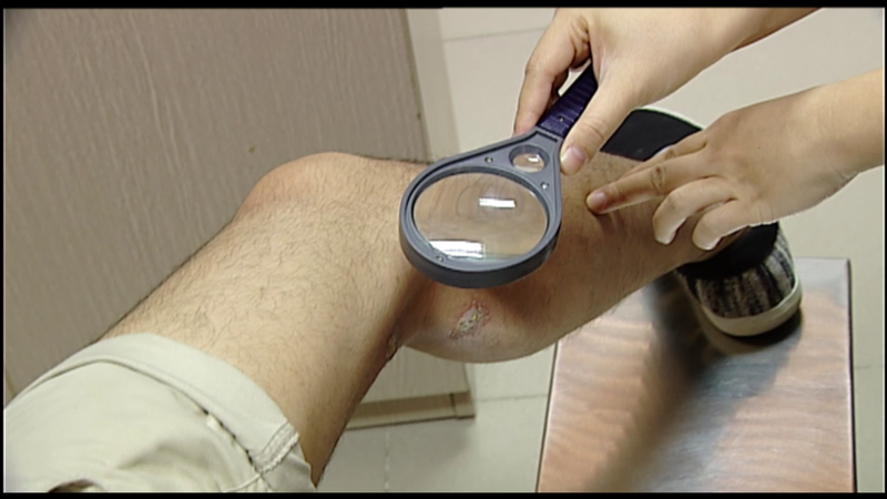 Gần 100 người nhập viện mỗi ngày vì tiếp xúc với kiến ba khoang