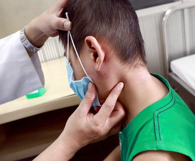 Gia tăng các ca mắc bệnh Whitmore, bệnh có lây từ người sang người?