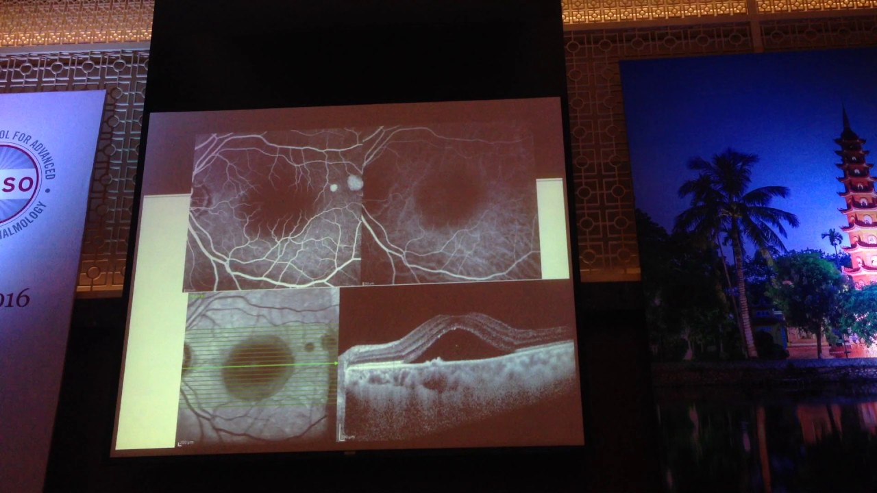 bệnh h&aacute;c v&otilde;ng mạc 