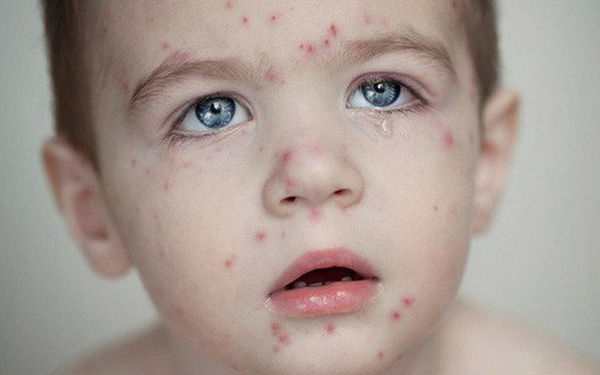 Hệ lụy không ngờ từ phong trào “anti-vaccine”