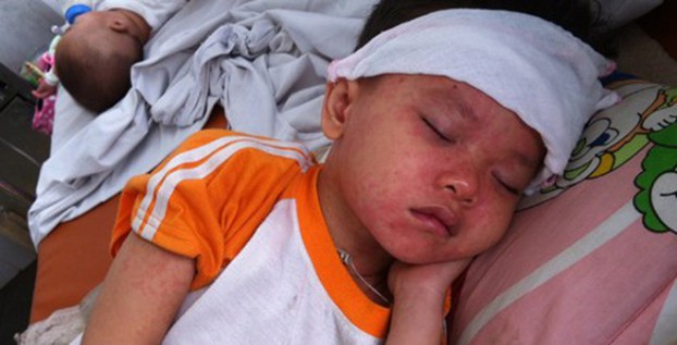 Dịch sởi ho&agrave;nh h&agrave;nh khắp nơi v&igrave; kh&ocirc;ng được ti&ecirc;m vacxin