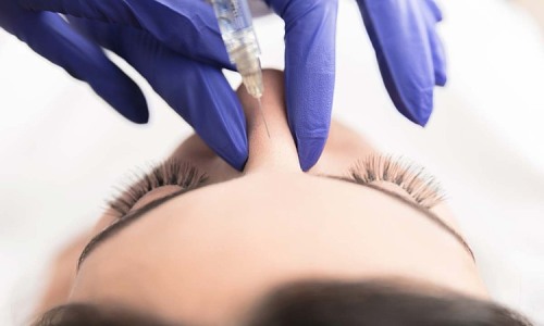 Hoại tử mũi sau tiêm filler thẩm mỹ