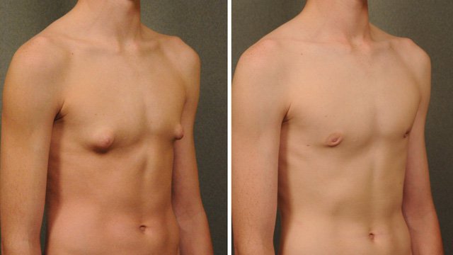 Hội chứng Klinefelter là gì? Các dấu hiệu để nhận biết hội chứng Klinefelter?