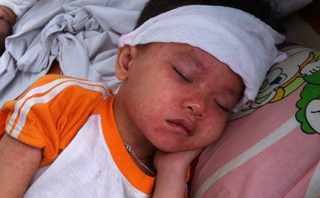 90% số ca mắc bệnh đều chưa tiêm phòng vacxin