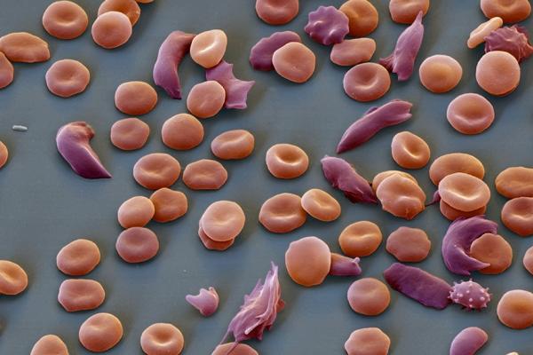 thiếu hồng c&agrave;u 