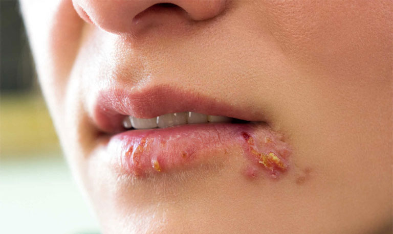 Hướng dẫn các cách điều trị chốc mép hiệu quả