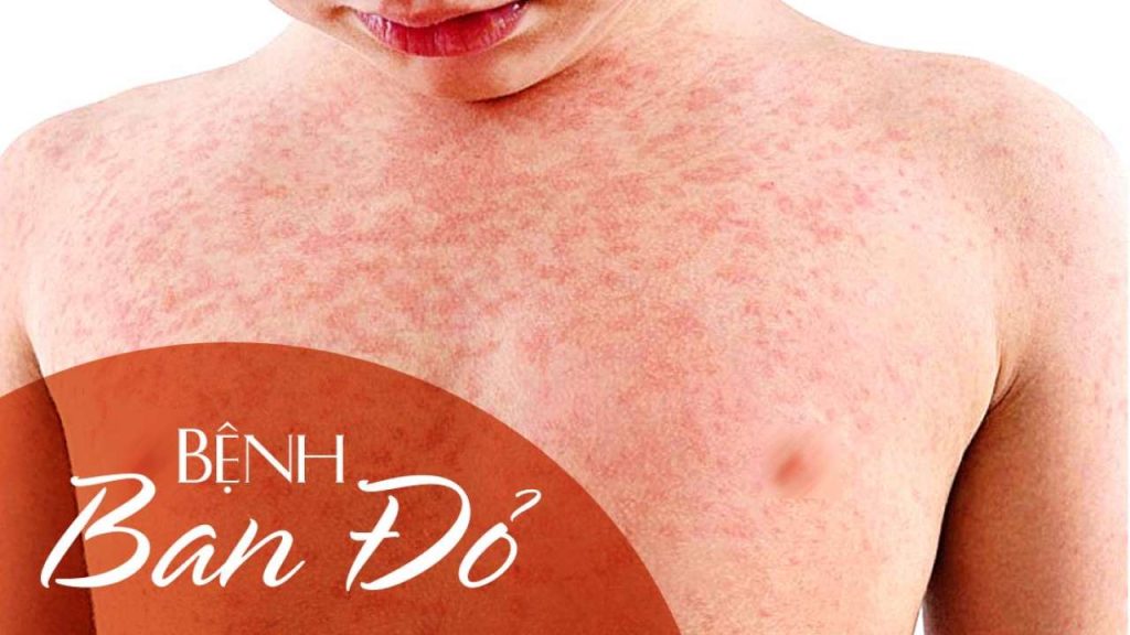 Làm thế nào để điều trị các triệu chứng của bệnh Lupus ban đỏ?