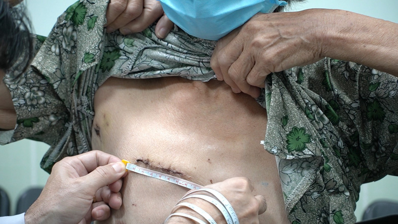 Lần đầu tiên tại Việt Nam: Áp dụng kỹ thuật phẫu thuật tim xâm lấn tối thiểu