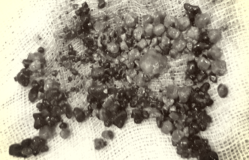 Loại bỏ hơn 200 viên sỏi túi mật cho nữ bệnh nhân