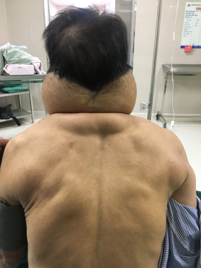 Một người đàn ông biến thành người khổng lồ sau nhiều năm nghiện rượu