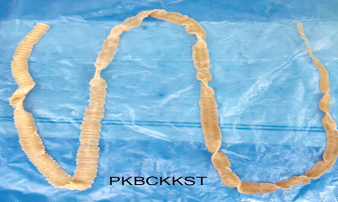 Hình ảnh sán dây 1m xổ ra từ bệnh nhân