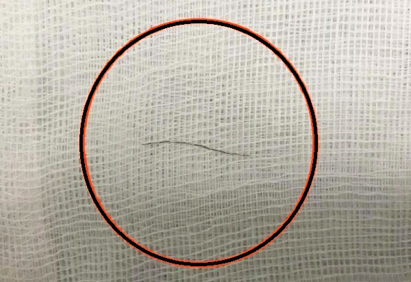 Nghệ An: Ăn cháo nấu sẵn bé 13 tháng tuổi bị mảnh thép cắm sâu vào họng