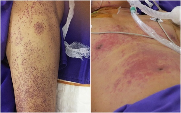 Người đàn ông nguy kịch vì nhiễm khuẩn liên cầu lợn