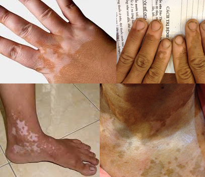 Điều trị bạch biến sẽ ngăn chặn sự đổi m&agrave;u tr&ecirc;n da