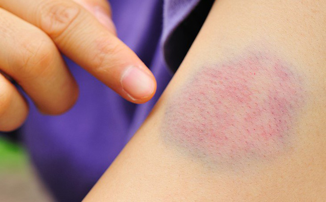 Chảy máu bên trong có thể gây ra vết thâm tím tại vị trí bị ngã