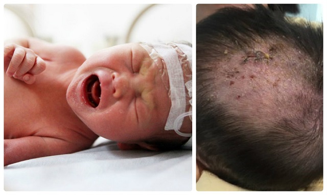 Bệnh chốc đầu là bệnh nhiễm trùng da do liên cầu khuẩn gây ra, thường gặp ở trẻ em dưới 5 tuổi