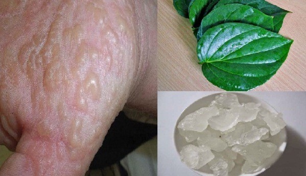 Có nhiều cách điều trị bệnh tổ đỉa hiệu quả