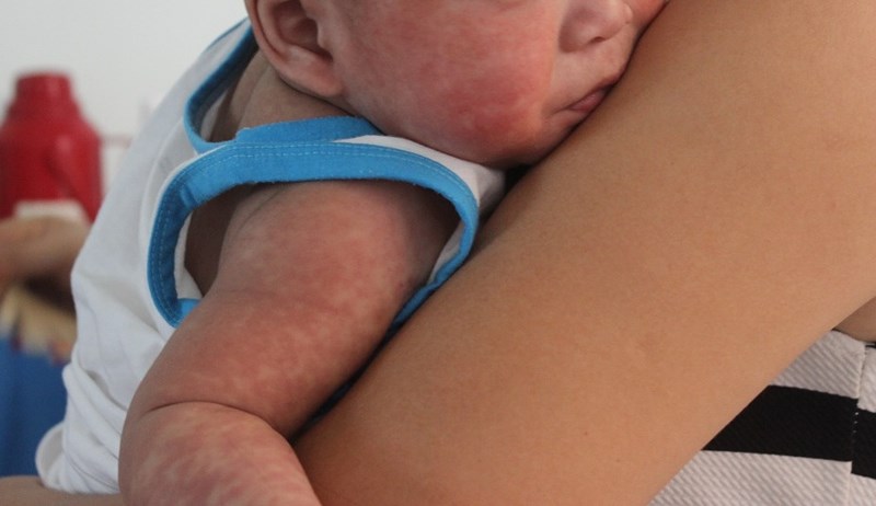  Nhiều trẻ em mắc dịch sởi v&igrave; thời tiết thay đổi