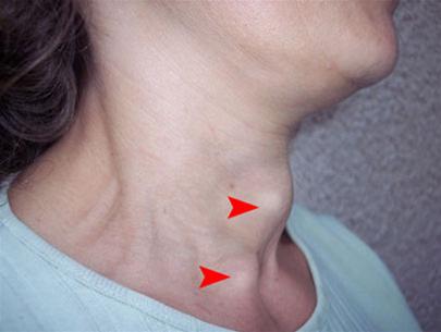 Những điều cần biết về bệnh Basedow