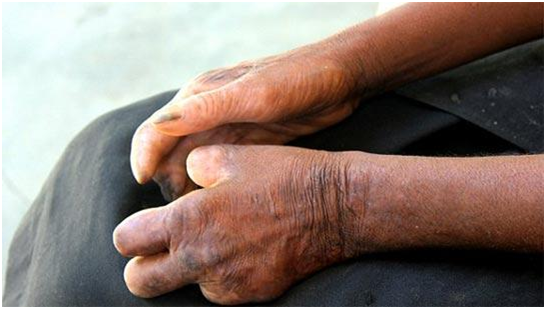 Những hiểu biết sai lầm về bệnh phong