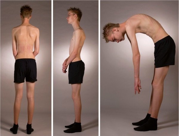 Những kiến thức bạn cần biết về bệnh gù cột sống