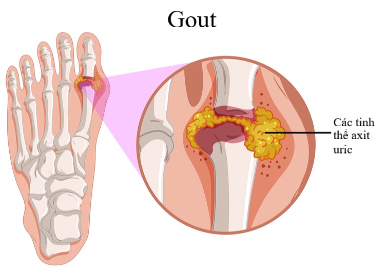 Những loại thuốc gout mạn tính tốt nhất hiện nay