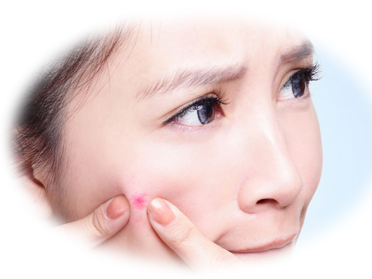 Nếu da nhạy cảm n&ecirc;n c&acirc;n nhắc sử dụng điều trị mụn bằng thuốc rượu