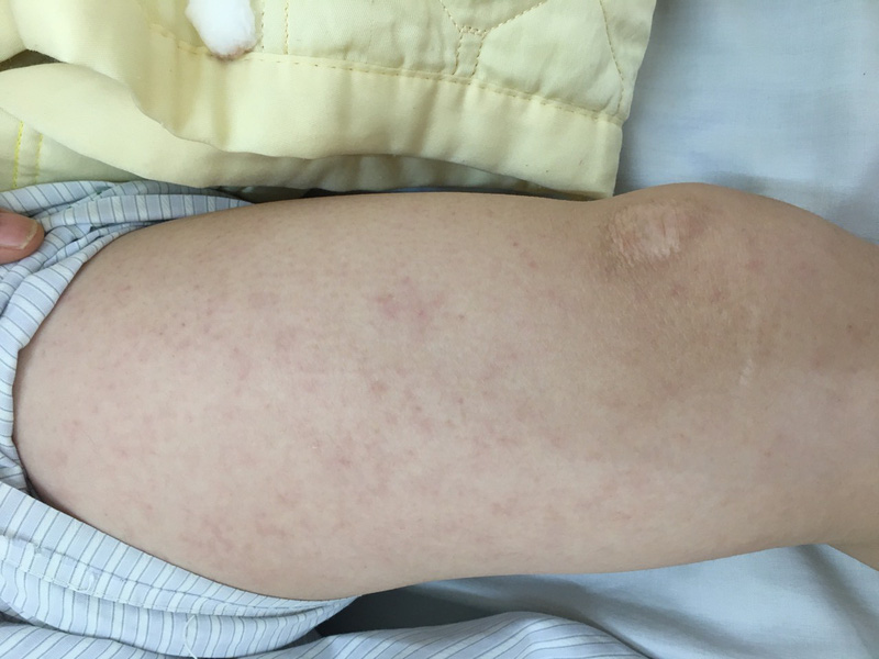 Vết ban đỏ tr&ecirc;n người bệnh nh&acirc;n ở H&agrave; Nội biến chứng vi&ecirc;m n&atilde;o do sởi