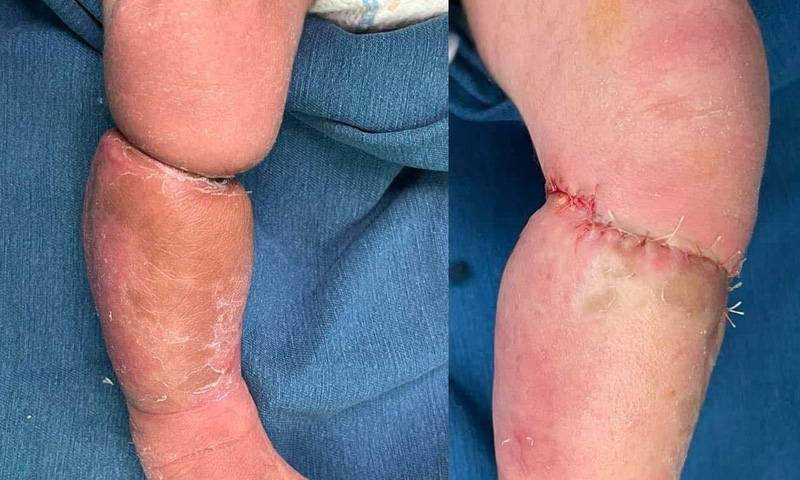 Phẫu thuật tạo hình cho bé trai sơ sinh mắc hội chứng vòng thắt bẩm sinh