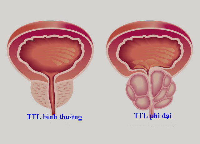 Phì đại ti&ecirc;̀n li&ecirc;̣t tuy&ecirc;́n
