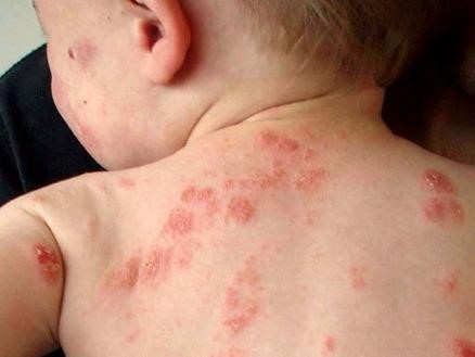 Phương pháp điều trị tốt nhất để giảm đau bệnh Zona thần kinh