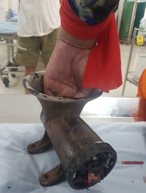 Rùng mình máy xay thịt nuốt gần hết bàn tay