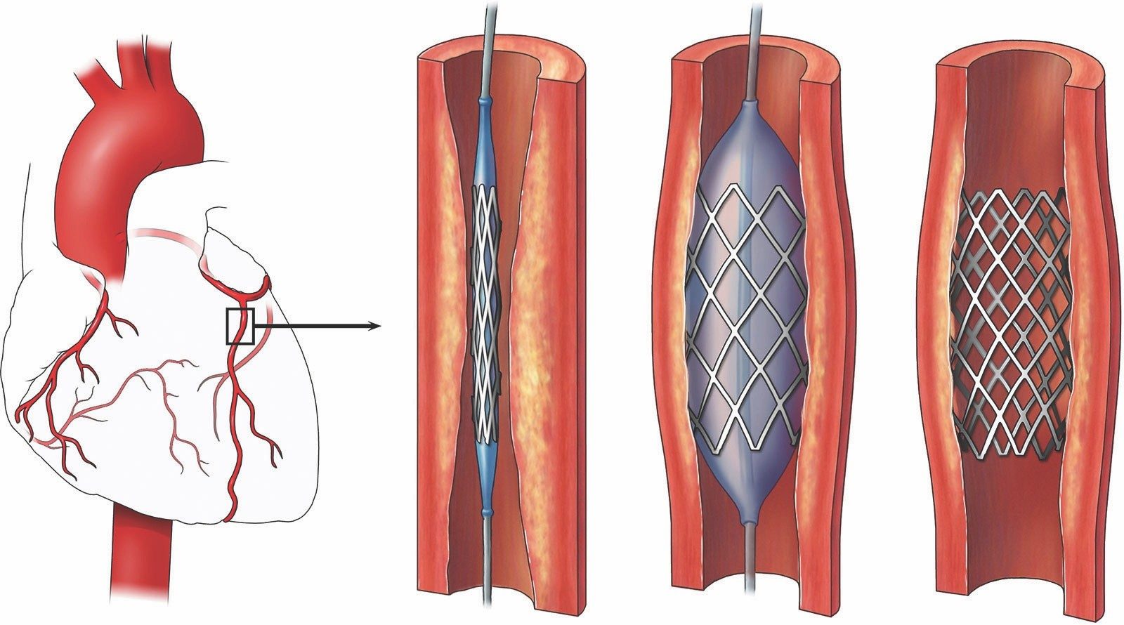 stent mạch v&agrave;nh