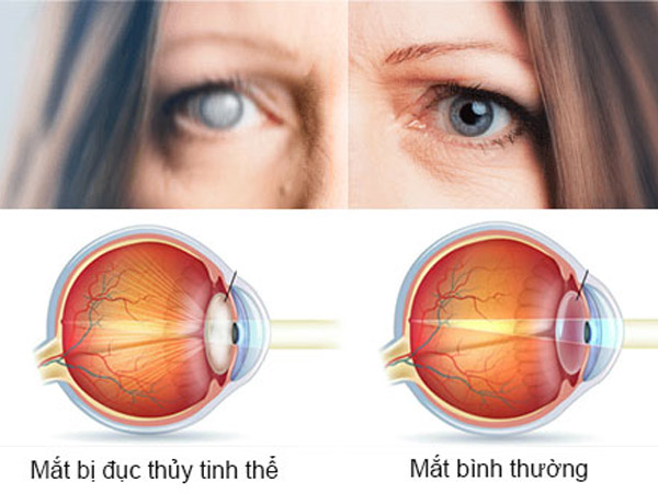 Vitamin B1 gi&uacute;p ph&ograve;ng ngừa đục thủy tinh thể